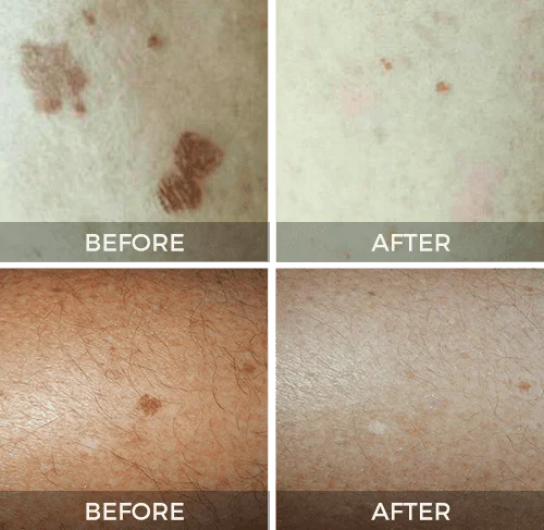 Skin Tag Removal